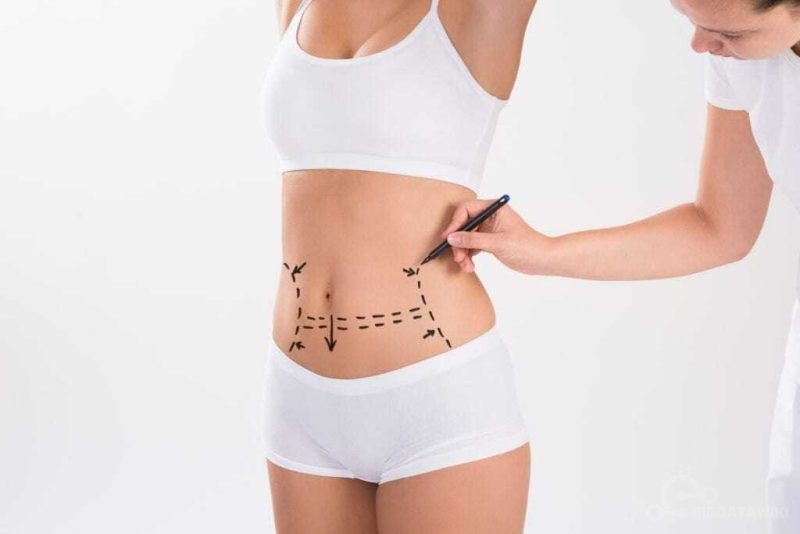 How to Get a Tummy Tuck Covered by Insurance?